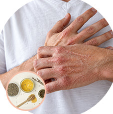 Home Remedies for Dry and Cracked Hands