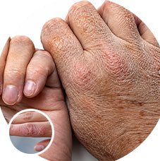 how to heal cracked skin​